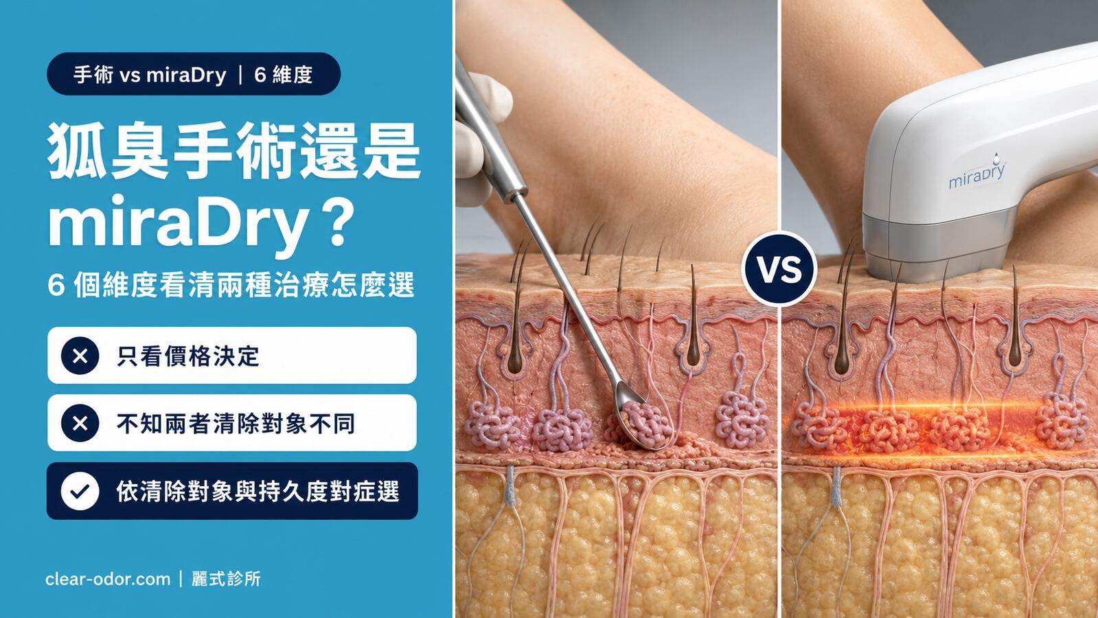 狐臭手術和 miraDry 微波治療哪個好?醫師解析 6 大關鍵差異