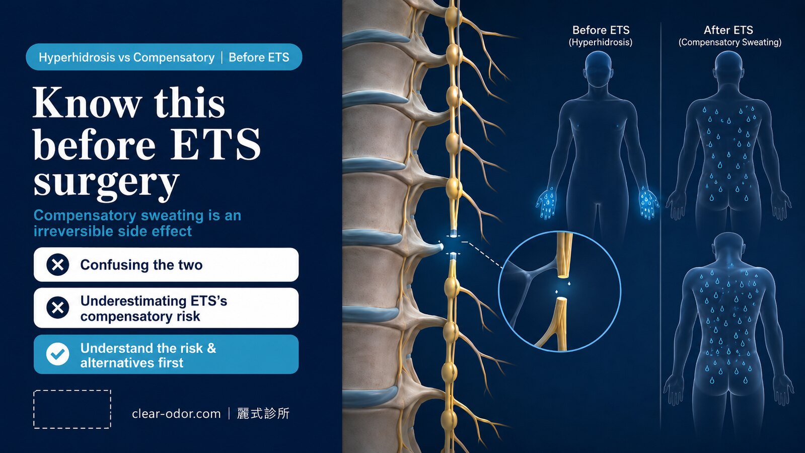 Hyperhidrosis vs Compensatory Sweating: What to Know Before ETS Surgery
