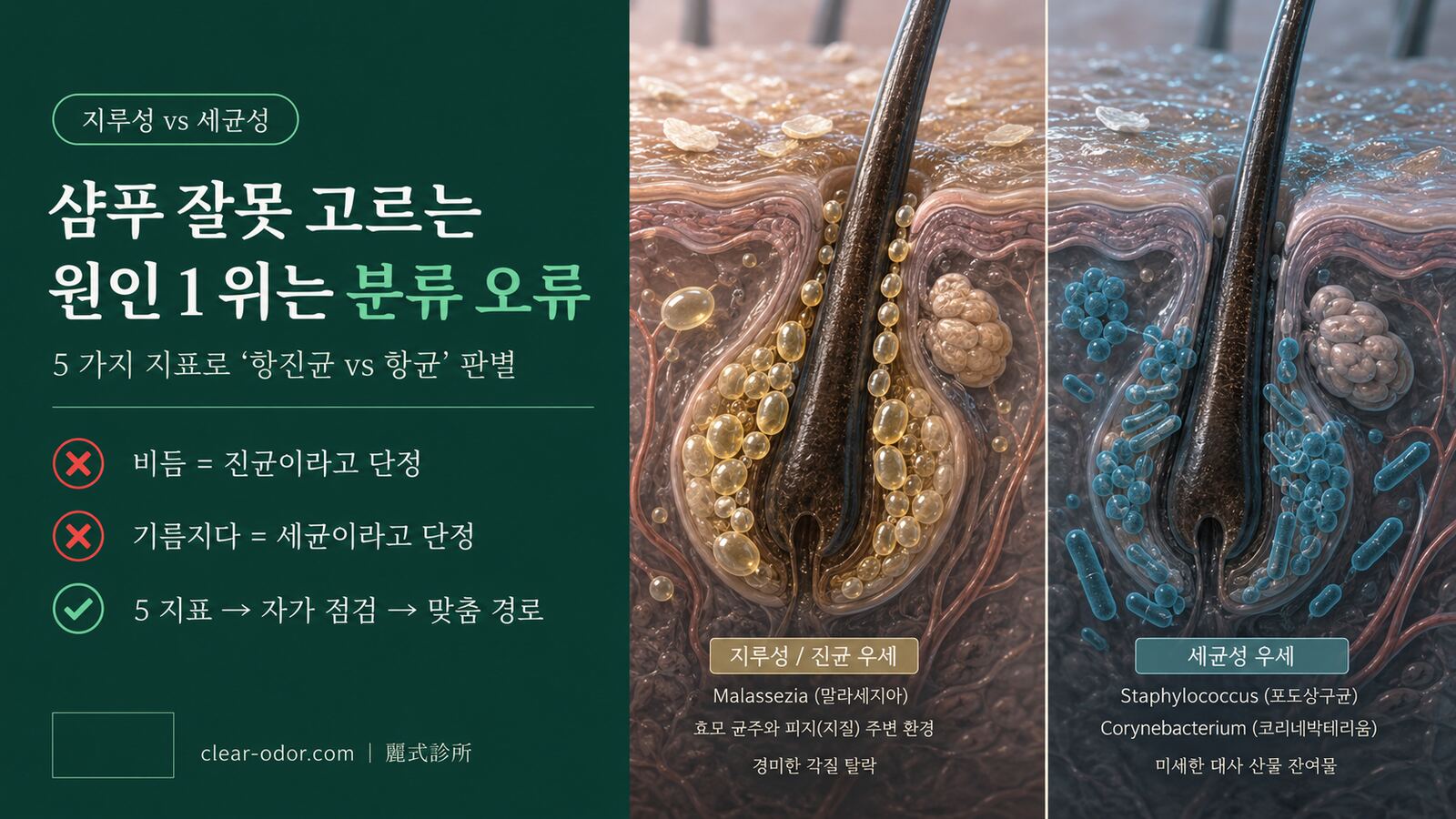 지루성 vs 세균성 두피 냄새: 유달유 원장이 알려주는 「항진균이냐 항균이냐」를 가르는 5가지 지표